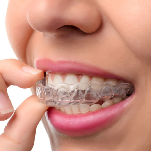 CLEAR ALIGNERS/ INVISALIGN in ahmedabad