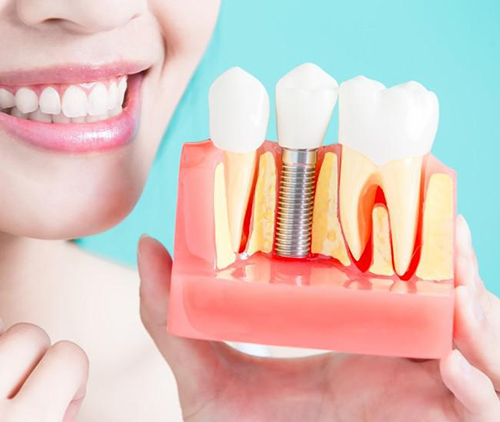 5 MYTHS AND FACTS ABOUT DENTAL IMPLANTS